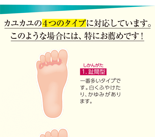 カユカユには4つのタイプに対応しています。このような場合には特におすすめです!1.趾間型