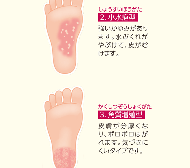 2.小水疱型。3.角質増殖型。
